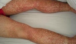 过敏性紫癜可以吃瓜吗,瓜类食物的适宜与禁忌