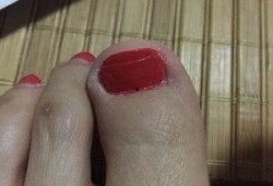 吃瓜甲沟炎,夏日饮食健康警示