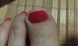 吃瓜甲沟炎,夏日饮食健康警示