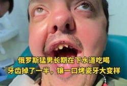 吃瓜牙掉了,吃瓜群众不慎掉牙，引发社会热议