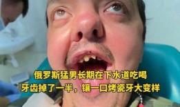 吃瓜牙掉了,吃瓜群众不慎掉牙，引发社会热议